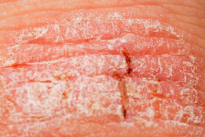 PSORIASIS CURE,PSORIASIS NIL,PSORIASIS TREATMENTS