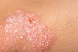 PSORIASIS CURE,PSORIASIS NIL,PSORIASIS TREATMENTS