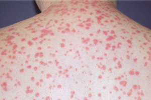 PSORIASIS CURE,PSORIASIS NIL,PSORIASIS TREATMENTS