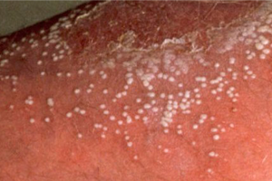 PSORIASIS CURE,PSORIASIS NIL,PSORIASIS TREATMENTS