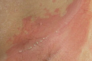 PSORIASIS CURE,PSORIASIS NIL,PSORIASIS TREATMENTS